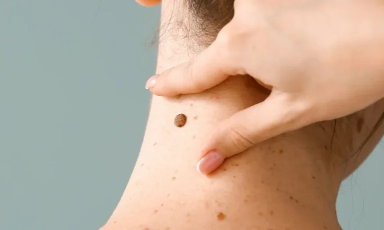 Tratamiento quirúrgico del cáncer de piel